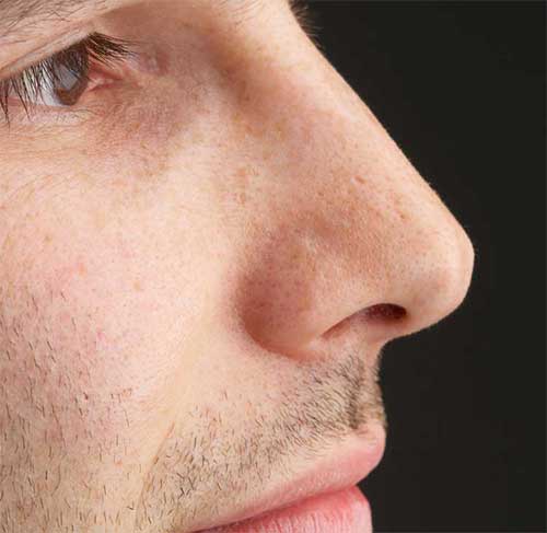 Men-Nose-Surgery
